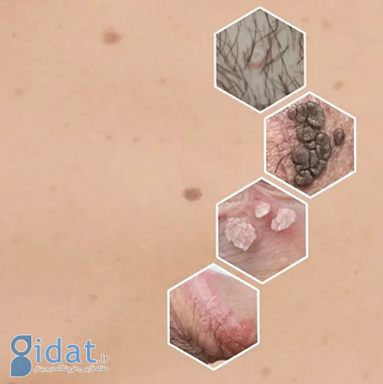 زگیل تناسلی